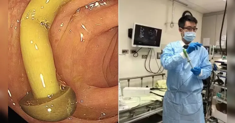 Médico descobre cogumelo crescendo no intestino de paciente